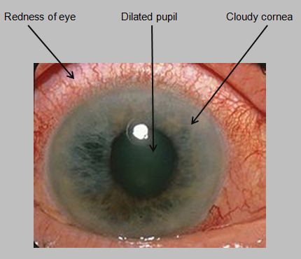 آب‌ سياه‌ چشم‌، نوع‌ زاويه‌ بسته‌ اوليه‌  Glaucoma primary angle closure